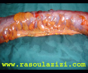 تصوير روده بزرگ مبتلا به  کوليت اولسراتيو  که توسط دکتر عزيزي از بدن بيمار خارج شده